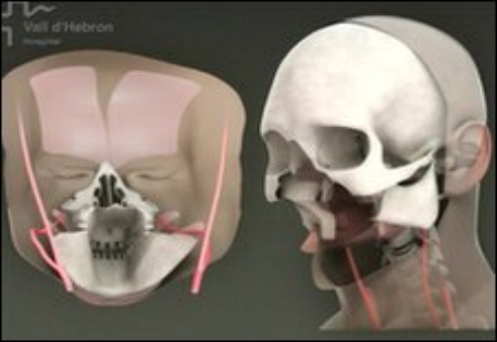 Испанские медики выполнили операцию по полной пересадке лица